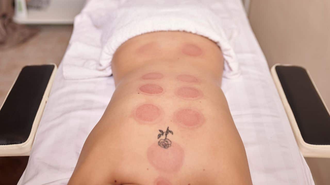 What Does Cupping Do For Athletes